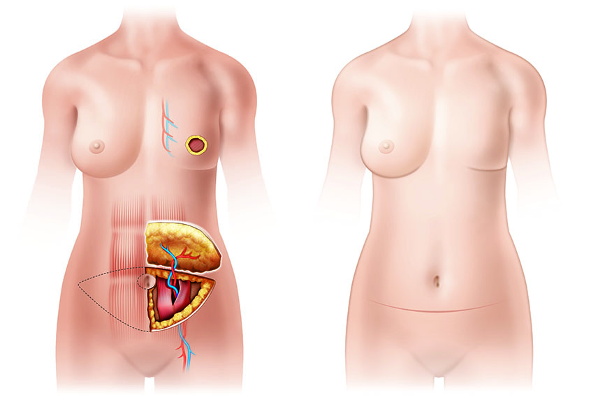 img/illustrations/ab_flap.jpg